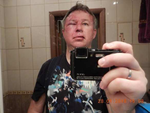 Избит сторонник Навального, обвинённый в мошенничестве людьми Ходорковского (ФОТО) | Русская весна