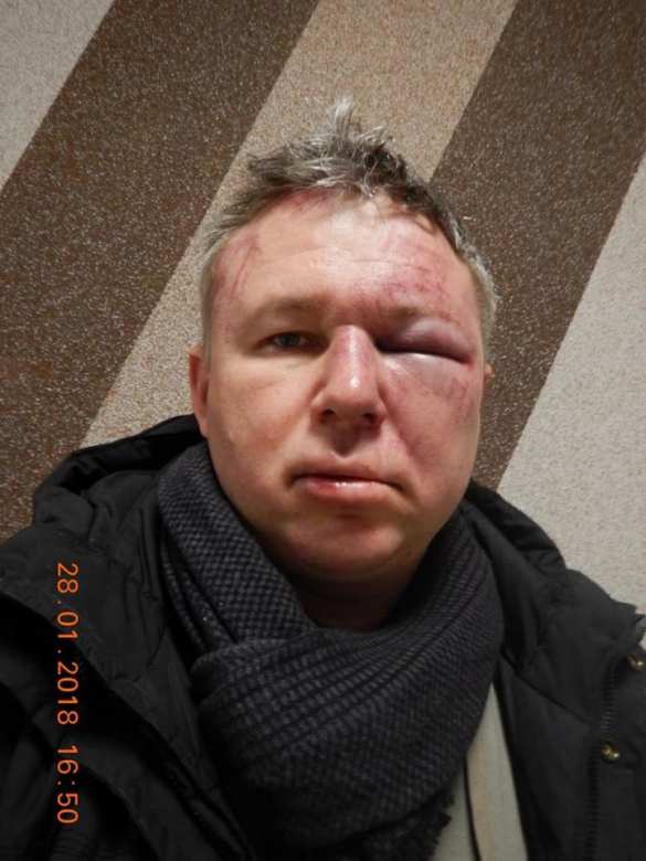 Избит сторонник Навального, обвинённый в мошенничестве людьми Ходорковского (ФОТО) | Русская весна