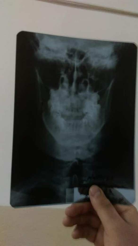 Карателю-«АТОшнику» сломали челюсть за выкрик «Слава Украине» (ФОТО) | Русская весна