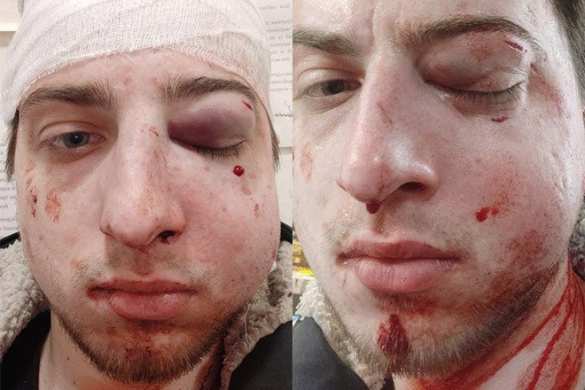 Поломанное лицо и ЧМТ: журналиста одиозного украинского СМИ жестоко избили в Киеве (ФОТО) | Русская весна