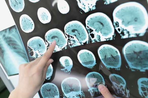 Болезнь молодых: в России стремительно растёт число пациентов с рассеянным склерозом | Русская весна