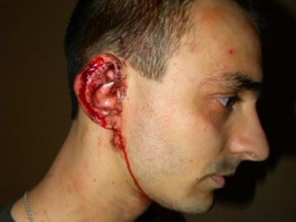 Львовскому активисту в драке откусил кусок уха прохожий, скандировавший «Слава Путину!» | Русская весна