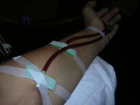 На Украине больные с почечной недостаточностью могут остаться без необходимого для жизни гемодиализа | Русская весна