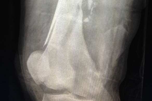 Инженеры смоделировали кровотечение после огнестрельного ранения ноги (ВИДЕО) | Русская весна