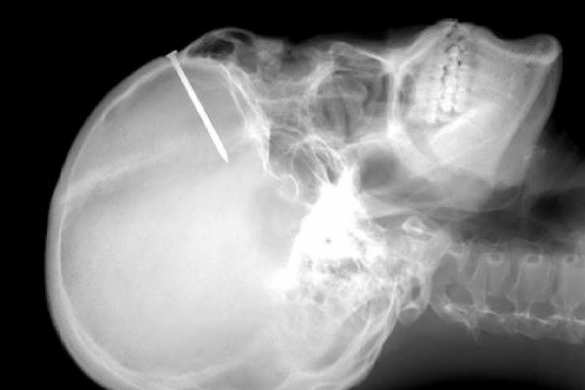 В России создали гель для восстановления костей со 100% идентичностью | Русская весна